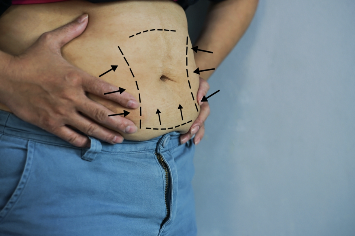 Is Cheap Weight Loss Surgery Safe and Worth It? Is Cheap Weight Loss Surgery Safe and Worth It?